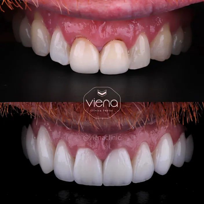 Clínica Viena / Veneers Medellín
