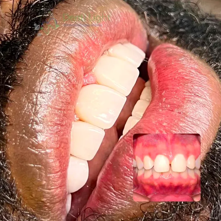 Denti light