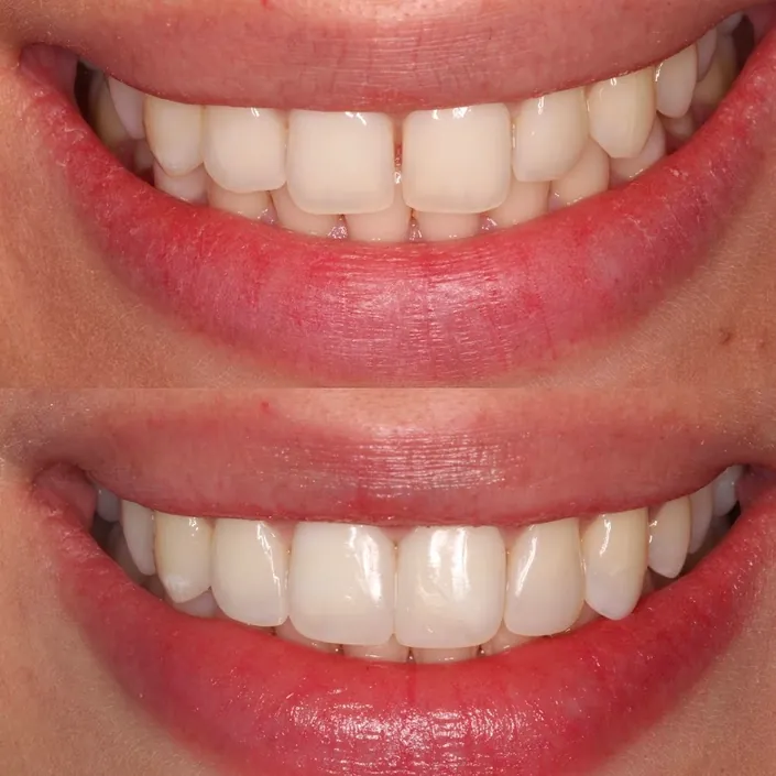 Doctora Veronica Diseño de Sonrisa en Bogotá Carillas de Porcelana Implantes Dentales Ortodoncia Invisalign