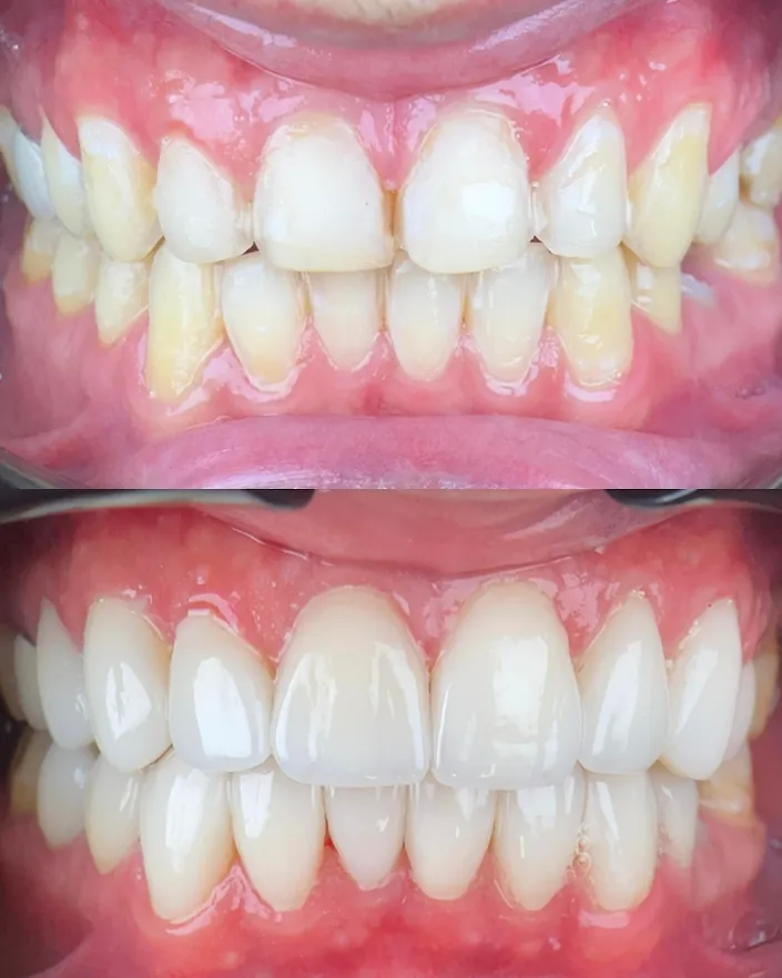 Elite Smile | Diseño de Sonrisa | Porcelain Veneers Barranquilla