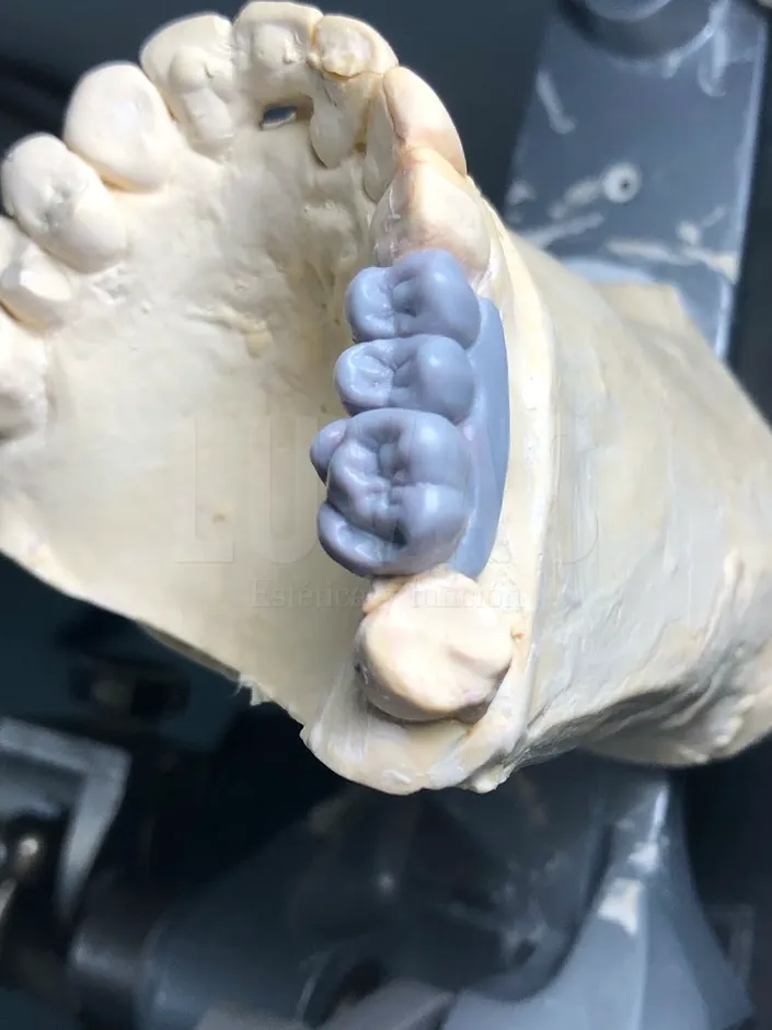 LUVAS laboratorio dental