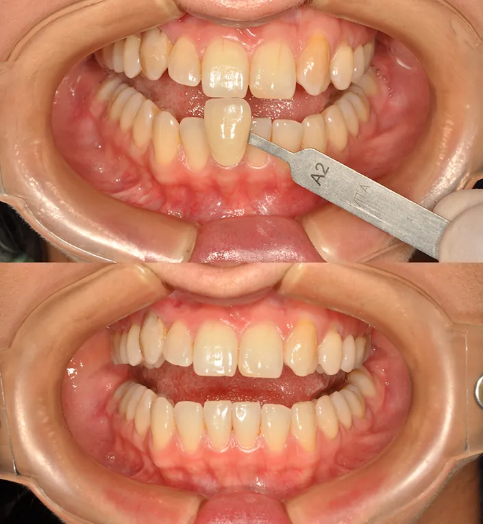 Odontología en Bogotá l Aclaramiento dental l Ortodoncia en Bogotá l Ortodoncia l limpieza dental l Clinica Dentu