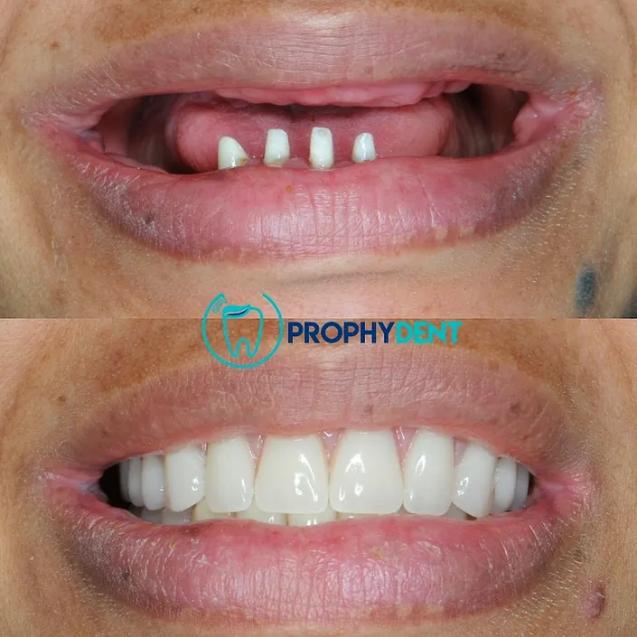 Prophydent